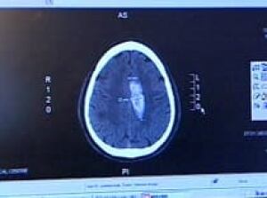 ctscan_stroke050607