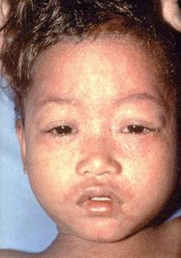 measles_child_cdc_050303