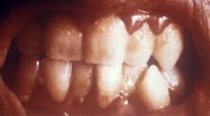 teeth_gingivitis_PHIL