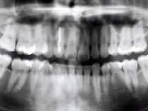 teeth-xray-cbc