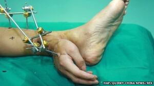 Hand grafted on ankle