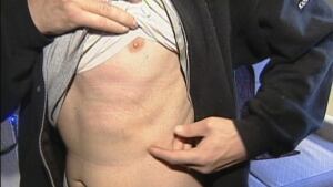John Benson's rib