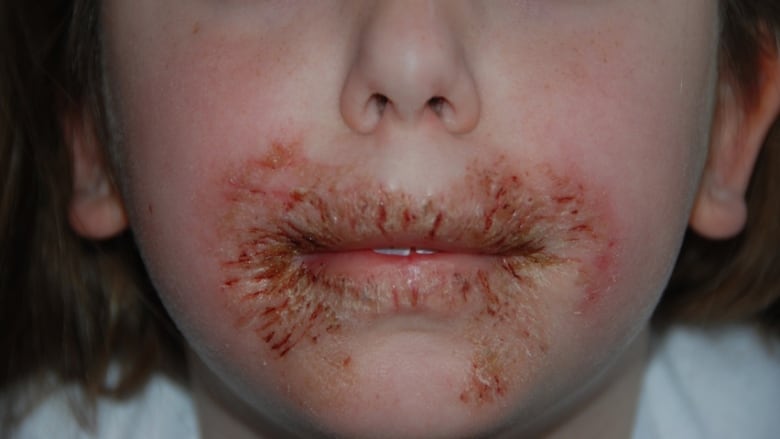 Rashes in Kids: age-by-age skin condition guide - Today's Parent