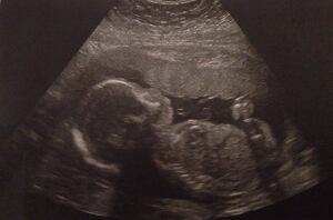 Robyn and Dylan Benson's unborn son - ultrasound scan