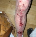 Genner's leg