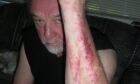 Genner's arm