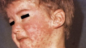 Measles rash