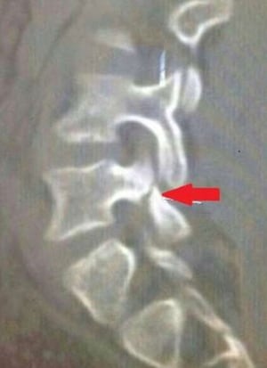 Neymar spine injury
