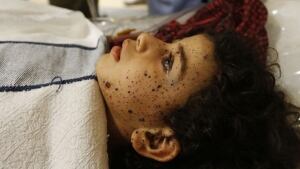 Injured Palestinian girl