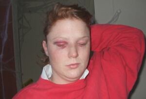 Cirbie Bishop injuries