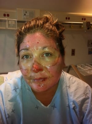 Kim Janvier refinery explosion injuries