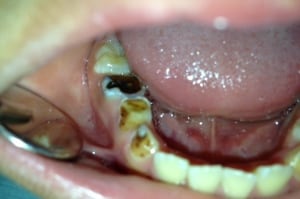 kids dental decay