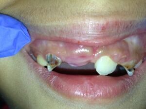 child dental decay