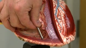 World's smallest pacemaker