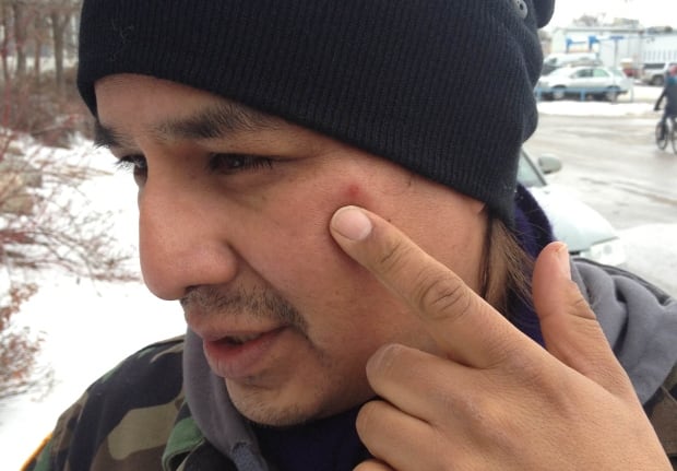 Simon Ash-Moccasin shows a mark on his face