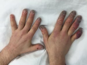frostbite
