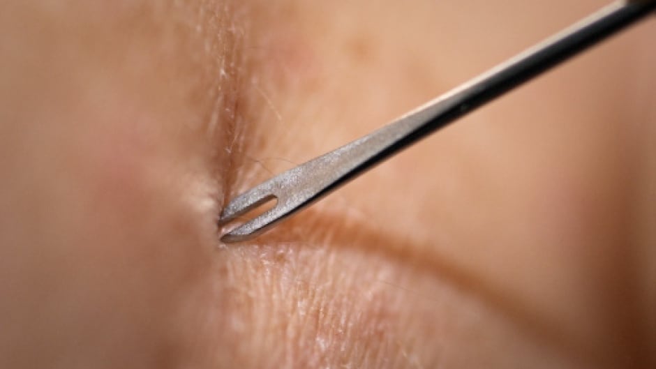 Clinician Demonstrates Use of Bifurcated Needle