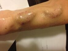 Alice Zhang says complaining about care got her kicked off B.C. kidney transplant list