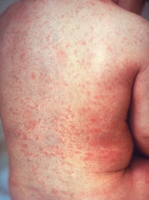 Rubella 5 Things 20150429