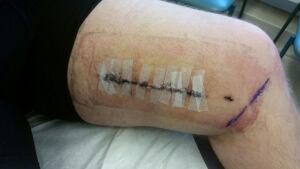 Kevin Maalouf Surgery