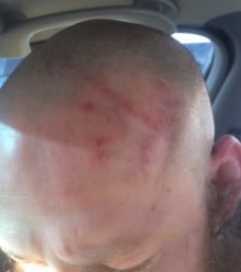 Hurt head