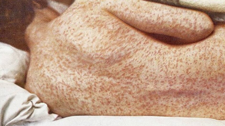 Woman with measles