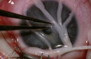 Donor nerve separated into fasciles before being attached to the cornea