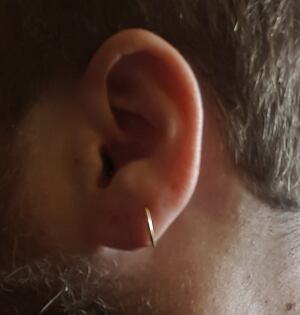 Kurt Barnett ear stretching surgery