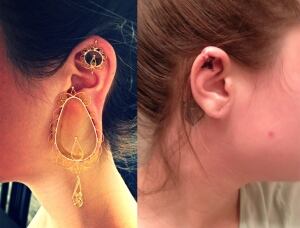Leanna Richard ear fix surgery