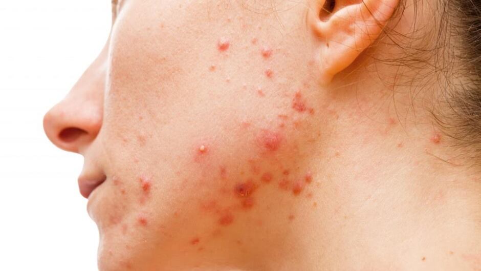 Accutane cost in canada