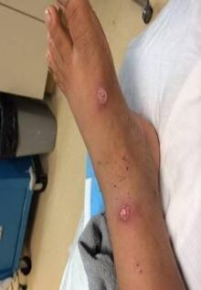 sores on children in Neskantaga