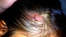 Wounded aboriginal woman