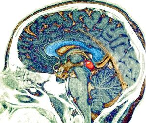 Pineal Cyst
