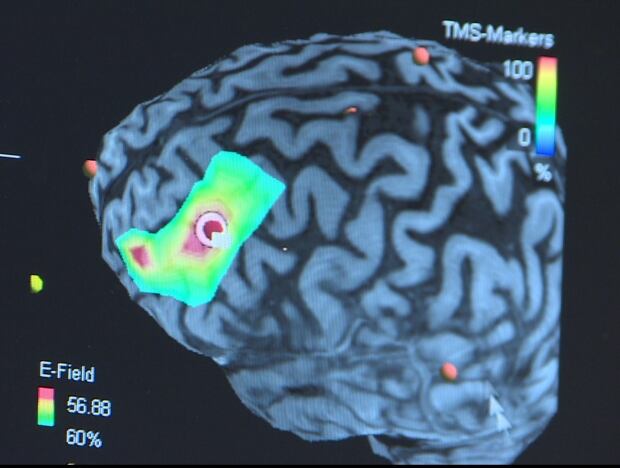 RTMS and the brain