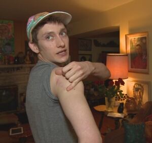Myles Keleher's scar