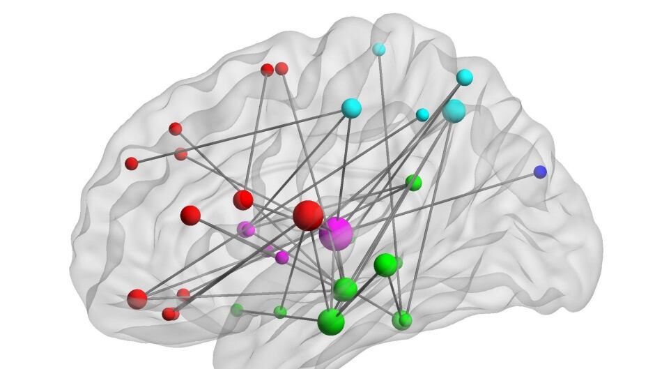 MEG imaging revealed unusual levels of connectivity between some brain regions in people with PTSD.