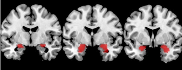 Amygdala
