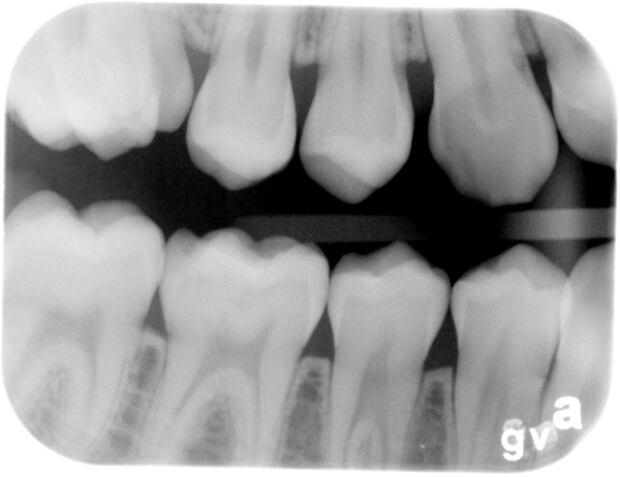 Bitewing radiograph
