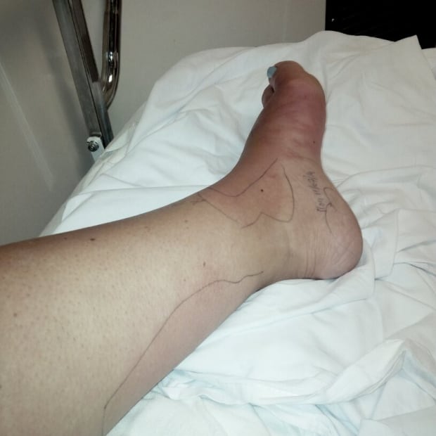 foot infection 3