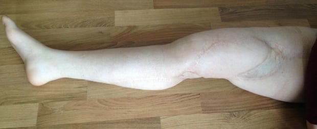 Amber Graveline's right leg