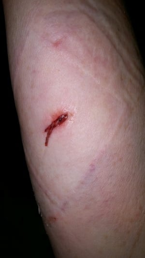 Tanis Cook dog bite
