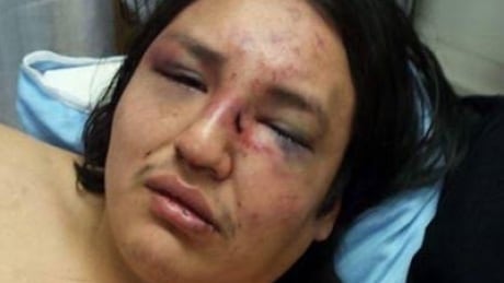 Photos of Christian Duck Chief were taken by his family as he was recovering in hospital. Christian Duck Chief