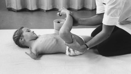 A child born malformed by the drug thalidomide learns to use their feet with therapist at the Heildelberg Orthopedic Clinic in Germany in the 1960s. 868882