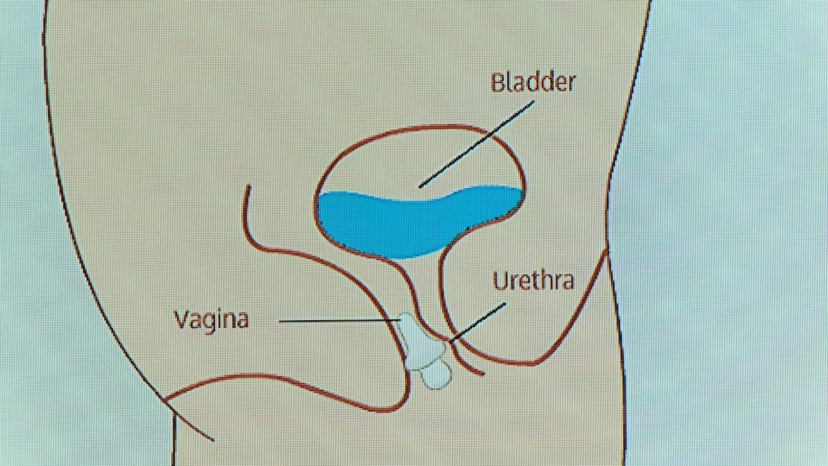 Shediac company set to go global with incontinence device CBC News