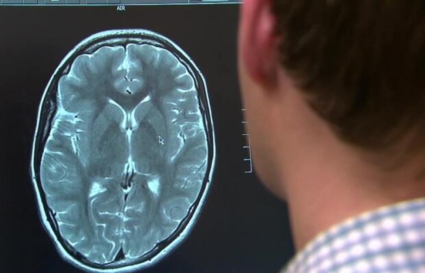 Concussions