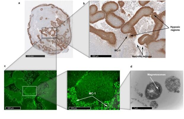 Hypoxic tumour