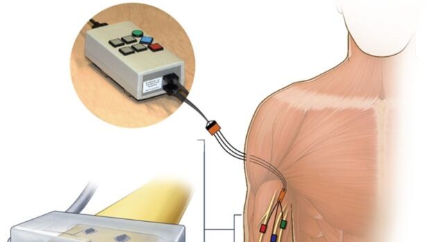 Next-generation prosthetic restores touch