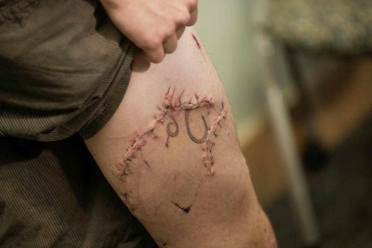 Surfer Tells Tale After Shark Attack In Pacific Northwest Cbc News