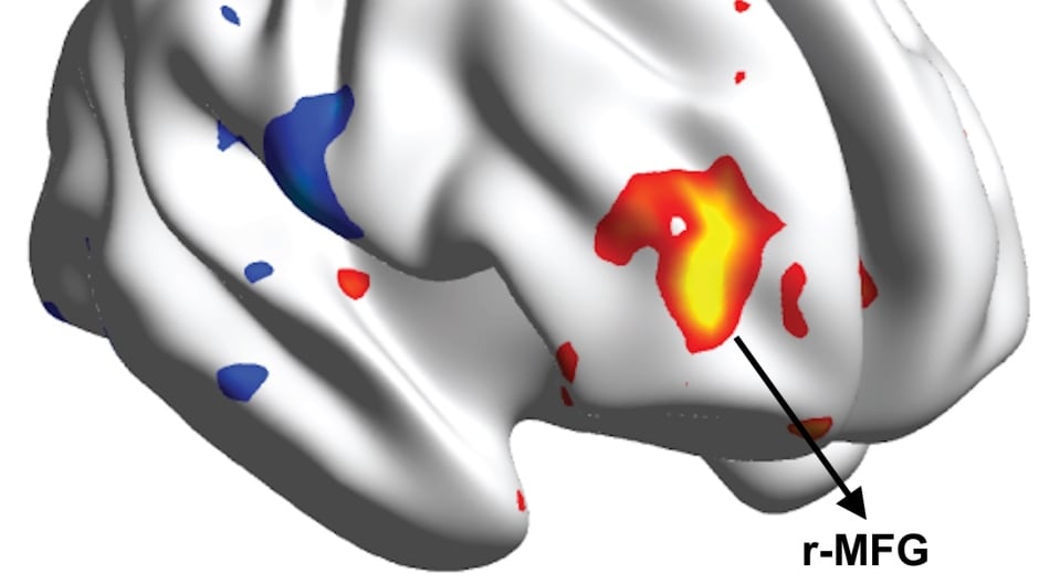 A fMRI slide of a placebo responder showing heightened activity in the mid frontal gyrus
