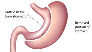 Gastric sleeve